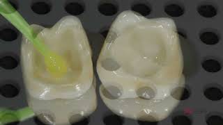 CEMENTACIÓN ZIRCONIA RELYX ULTIMATE [upl. by Ellerol371]