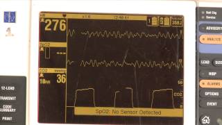 Waveform capnography demonstration [upl. by Sukramed154]