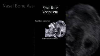 How to Accurately Assess The Fetal Nasal Bone [upl. by Ydda]