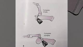 METACARPOPHALANGEAL DISLOCATION THUMB [upl. by Kipper]