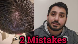 Hair Loss Mistakes  My Hair Journey  FAILED [upl. by Roselani]