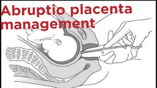 Abruptio placenta management [upl. by Keyek597]