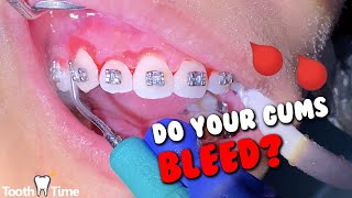 braces gum swellingbleeding  Why and what to do  Tooth Time Family Dentistry New Braunfels [upl. by Barthol]