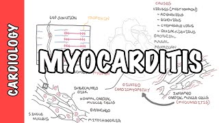 Myocarditis  causes pathophysiology investigation and treatment [upl. by Anivas]