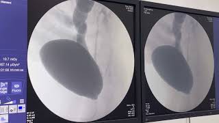 Uretrocistografia retrógrada miccional UCM em paciente com Refluxo vésico ureteral [upl. by Ahsilat796]