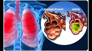 Acute Respiratory Distress Syndrome ARDS [upl. by Asilrahc]