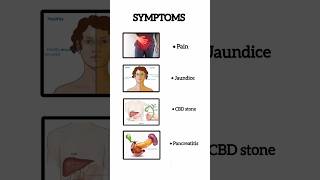 Gall bladder stones  When to get surgery done [upl. by Atiuqehc]