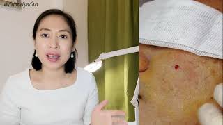 How I Treat Deep Acne Scars  the punch excision technique [upl. by Alesi]