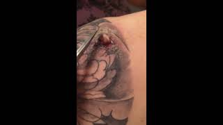 Infected abscess on tattoo [upl. by Assirk820]