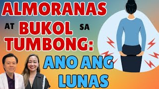 Almoranas at Bukol sa Tumbong Ano ang Lunas  By Doc Willie Ong [upl. by Esikram]