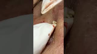 Big Cystic Acne Blackheads Extraction Blackheads amp Milia Whiteheads Removal Pimple Popping [upl. by Oicnoel]