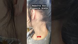 Alopecia Areata Treatment Houston Trichologist alopecia hairloss [upl. by Jacoba]