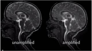 Chiari Malformation l video [upl. by Maurits]