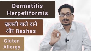 Dermatitis Herpetiformis  खुजली वाले दाने और Rashes Gluten Allergy Itching water filled rashes [upl. by Sevart20]