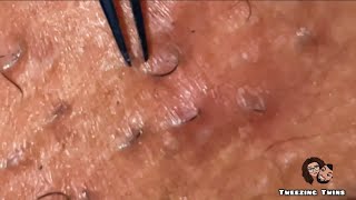 Ingrown Hair Removal Ep24 [upl. by Thgiwd]