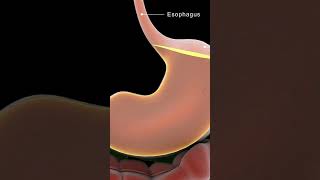 Understanding Achalasia Cardia  Causes amp Solutions [upl. by Pell372]