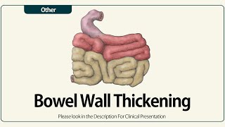 Linear EUS Bowel Wall Thickening [upl. by Sylvia]