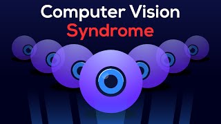 How I CURED my EYE STRAIN Relief from Computer Vision Syndrome [upl. by Wendin]