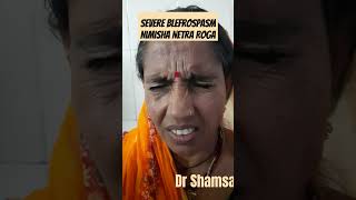 A Case of Blepharospasm Nimisha Netra Roga niajaipur dr Shamsa fiaz [upl. by Beitch]