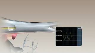 Swan Ganz™ Animación de colocación de Catéter [upl. by Diskin]