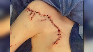 9YearOld Who Survived Shark Attack Left With 120 Stitches [upl. by Gneh341]