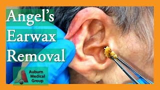 Angels Earwax Removal  Auburn Medical Group [upl. by Peckham676]