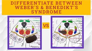 Midbrain Syndromes  Benedikts VS Webers syndrome [upl. by Tekcirc]