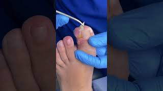 DEDO CON FIBROMA ingrowntoenailsurgery [upl. by Clova]