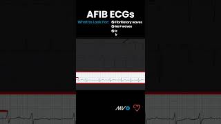 What to Look for in an AFib ECG [upl. by Nahtannoj997]