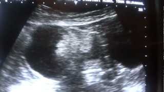 DERMOID CYST ultrasound [upl. by Orelee]