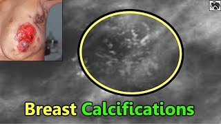 Breast Calcifications  Types and Causes of Breast Calcifications [upl. by Pietra622]