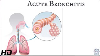 Acute bronchitis Everything You Need To Know [upl. by Hernardo]