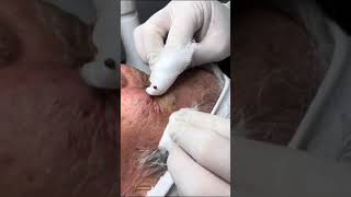 Pimple popping pimple removal treatment 137 blackheadremoval [upl. by Konstanze994]