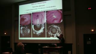 Aspect en endoscopie et échoendoscopie des tumeurs sousmuqueuses digestives  Dr L PALAZZO Paris [upl. by Geis]