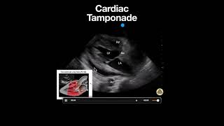 Cardiac Tamponade PSLA [upl. by Ettelrac445]