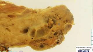 Pancreas Carcinoma gross pathology [upl. by Gudrun]