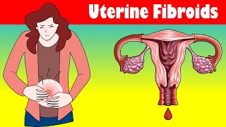 Uterine Fibroids Signs And Symptoms Types Causes And Treatment [upl. by Kaya]