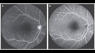 Vaskulitis der Retina bei Takayasu Arteriitis [upl. by Tenney]