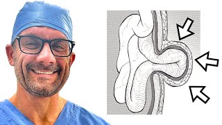 Umbilical hernias  What are they and when do we treat them [upl. by Nosnirb]