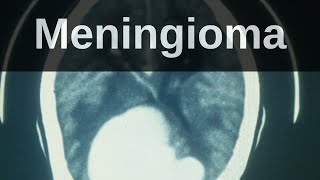 What is a Meningioma Pathology mini tutorial [upl. by Alletnahs]