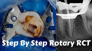 Live Steps Root Canal Rotary Protaper Endodontic Procedure ACP BMP obturation irrigation [upl. by Oliva]