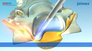 CESSYS®  Cervical Endoscopic Surgery System [upl. by Aicinat380]