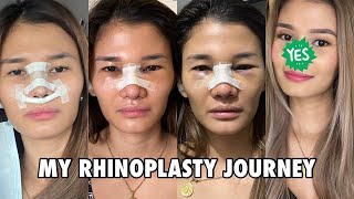 MY RHINOPLASTY JOURNEY  Was it worth it  Jen Barangan [upl. by Burnley413]