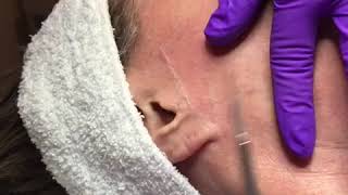 Dermaplaning  Artemedica Spa  Santa Rosa [upl. by Gnol]