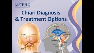 Chiari Malformation Diagnosis amp Treatment Options [upl. by Kylstra]