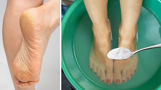 Get Rid of CRACKED HEELS Permanently  Magical Home Remedy [upl. by Oilegor419]