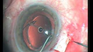 scleral fixation of dislocated iolwmv [upl. by Ashraf]