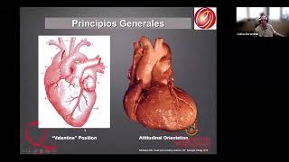 EXTRASÍSTOLES VENTRICULARES LOCALIZACIÓN MEDIANTE ECG DE SUPERFICIE PREPARANDO LA ABLACIÓN [upl. by Omidyar]