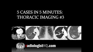 5 Cases in 5 Minutes Thoracic 3 [upl. by Aiset]