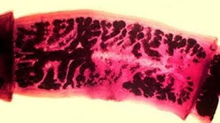 Cysticercosis of the Humanoid Nervous System [upl. by D'Arcy]